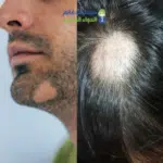 تركيبه التعلبه
