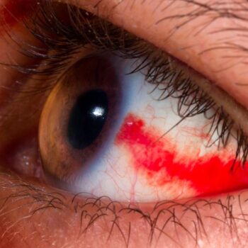 Hydrocortisone eye 2.5-هيدروكورتيزون عين