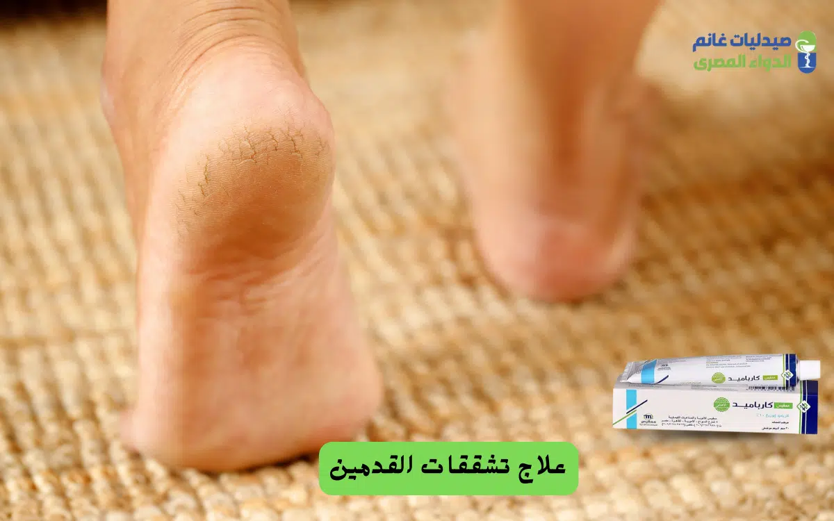 علاج تشققات القدمين